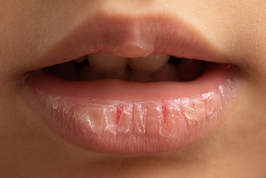 A little girl's chapped lips due to cold and dehydration